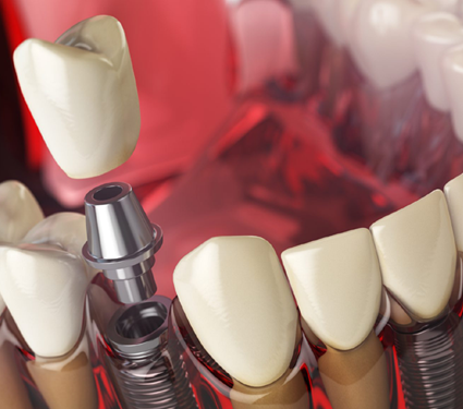 Best Dental Clinic in Trichy