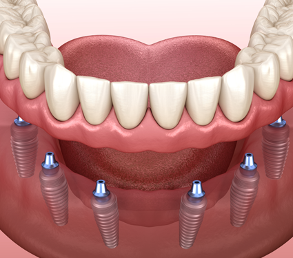 Best Dental Clinic in Trichy