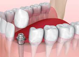 Best Dental Clinic in Trichy